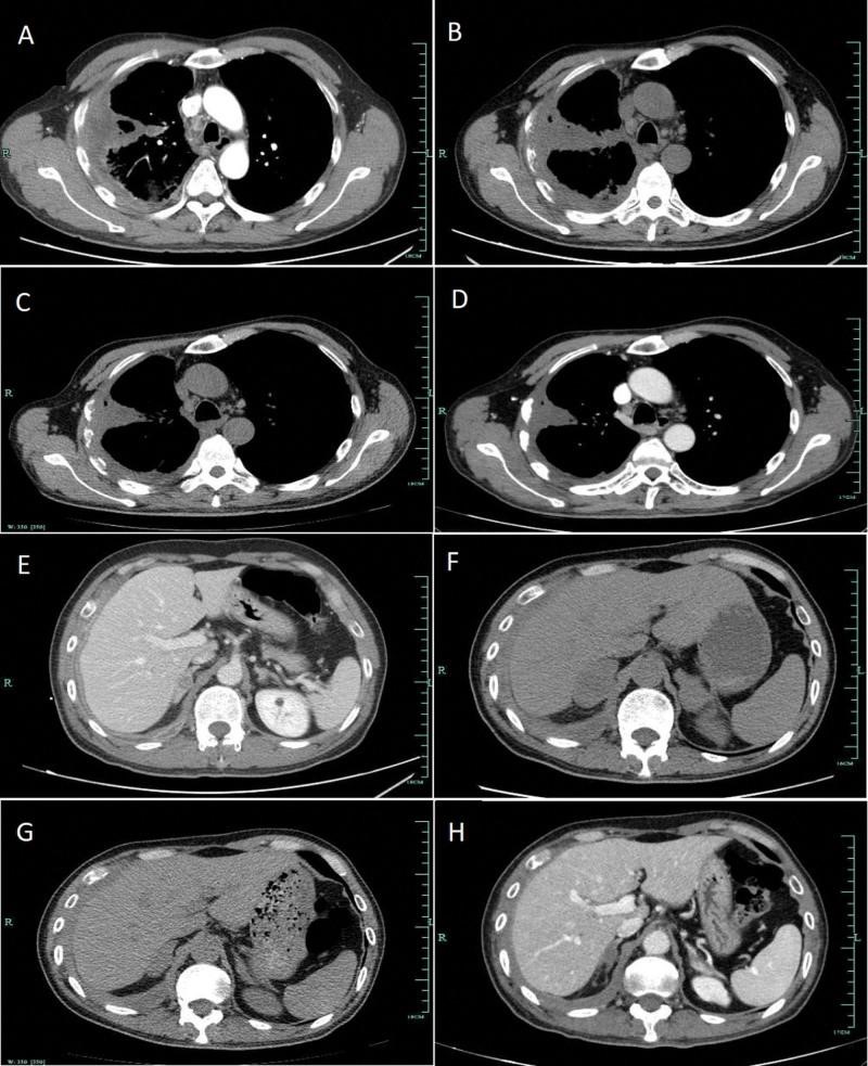 【佳学基因检测】基因检测鳞细胞肺癌EGFR突变伴PD-L1表达后的制定出帕博利珠单抗靶向药物治疗 【佳学基因检测】基因检测鳞细胞肺癌EGFR突变伴PD-L1表达后的制定出帕博利珠单抗靶向药物治疗